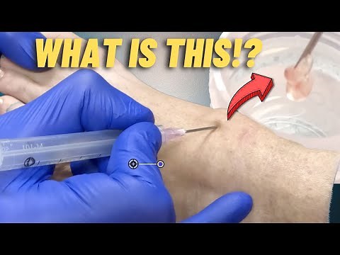 Draining a Ganglion!