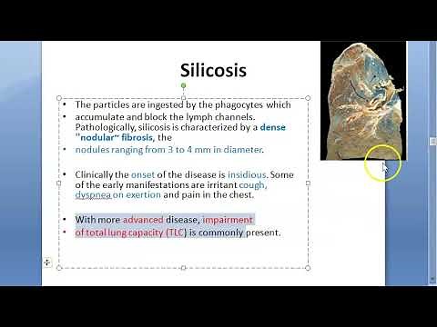 PSM 843 Silica dust Silicosis Lung
