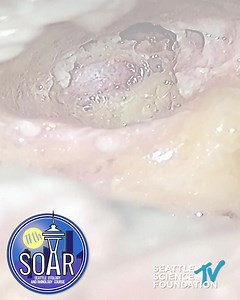 James Prueter DO from @ketteringhealth performed a total #endoscopic #FaciaNerve decompression at our 11th Annual Seattle #Otology and #Rhinology Course or #SOAR exposing the #cochlea and #Carotid #Artery. The hands on labs at our courses offer unprecedented access and #learning opportunities. Sign up for our course at SSFCME.ORG #anatomyclass #humananatomy #Mcat #biology #humanbiology #dissection #cadaver #doctor #picoftheday #learn #SSF #medicine #medicalvideo #biologyvideos #science #cadaver 