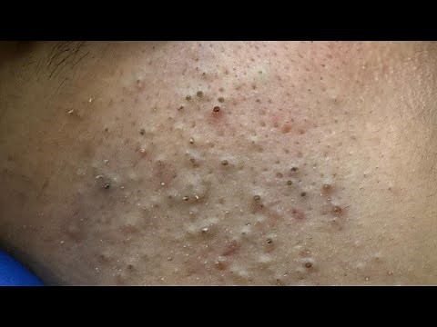 [ASMR] Satisfying Blackhead Extraction and Facial Cleansing for Clear Pores