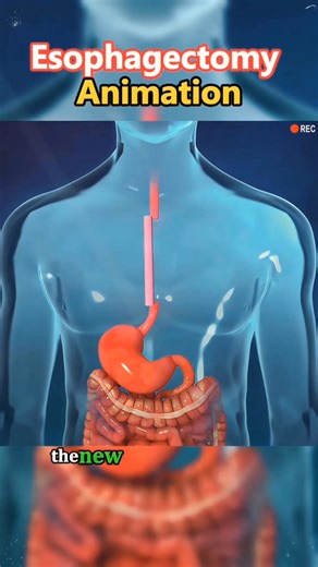 Witness the Future of Surgery in 3D This Esophagectomy 3D Animation shows the precision, skill, and innovation behind life-saving procedures. Watch how advanced medical technology transforms complex surgeries into visual perfection. Knowledge is power, share to spread medical awareness #MedicalAnimation #Esophagectomy #3DMedicalVideo #SurgicalEducation #MedicalStudents #HealthcareInnovation #AnatomyIn3D #SurgeonLife #MedicalTechnology #FutureOfMedicine #SurgeryExplained #ViralMedicalVideo #MedEd