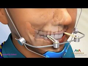 Orthodontic Treatment for Underbite or Crossbite - Facemask or Reverse Pull Headgear