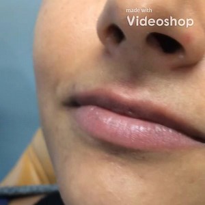 It is AAFE Lips 👄 Week! NEW LIVE ONLINE LIPS TRAINING FREE THIS TUESDAY OR WEDNESDAY! New HD Video treatment including the all new Comfortox Micro-Cannula technique as we follow a patient through Lip volume, keyhole pout, Botox lip flip, right angle lips and more! Register with the link in our profile or go to http://bit.ly/BotoxFillerLipsTraining now. This free training will fill to capacity. See you at this all new live AAFE training! Your patients will love you more than ever as you bring th