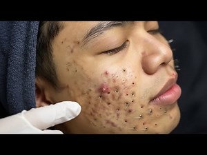Loan Nguyen Acne Treatment 32m