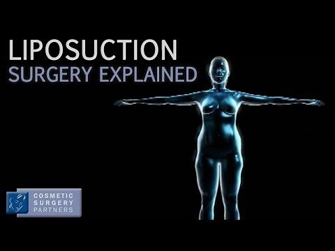 Liposuction explained - Cosmetic Surgery video animation