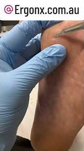 Satisfying Corn Removal with Scalpel Instant Relief Podiatrist #FootHealth #OddlySatisfying
