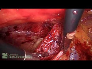 Laparoscopic Bilateral Hernia Repair: Direct & Indirect Defects | Dr. Todd Harris (4k)