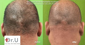 Laser Treatment For Bumps on Back of Head By Dr. U
