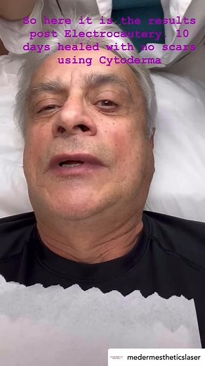 Thank you @medermestheticslaser for sharing your experiences using CytoDerma post procedure. —————————————————————-So here it is the results post Electrocautery. 10 days healed with no scars using CytoDerma. #cytoderma #siliconegel #scarmanagement #scarcare #scarhealing #aesthetics #vaughan | Cytoderma