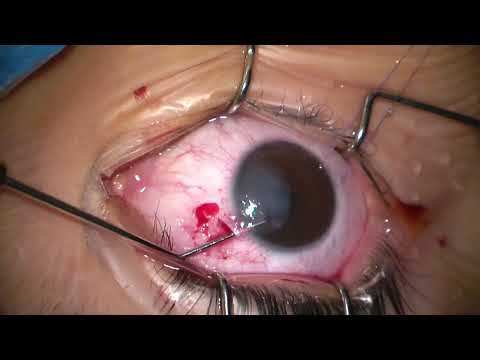 Surgical Management of Intrastromal Corneal Cyst
