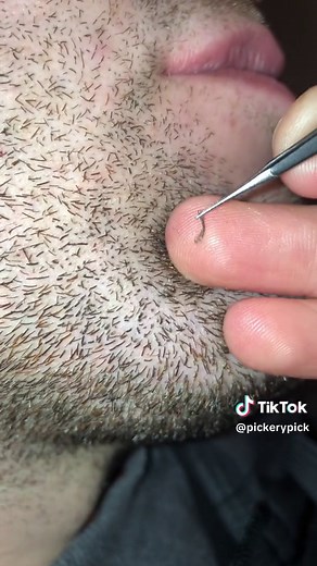 Chin Hair Plucking Routine: 11 Hairs in 1 Minute