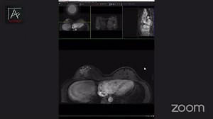 [E-Learning] 📣 IRM mammaire dans la pratique quotidienne du médecin radiologue 📣 Artifact lance une nouvelle session de formation en « IRM mammaire dans la pratique quotidienne du médecin radiologue » avec Dr S. DERROUIS 🤩 🇩🇿 🇨🇭 🔗 https://forms.gle/FcSDazoM8dh6iaRf9 📆 Février 2022 ⬇️ Extrait de notre précédente session. Contact ? 📞 0550 989 154 - 0782 678 763 ✉️ artifact.contacts@gmail.com #Artifact #FMC #Radiologie #IRM | Artifact