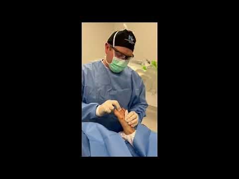 Minimally Invasive Hammertoe Surgery: From Start to Finish