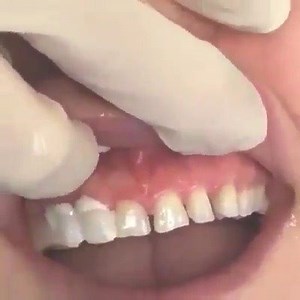 Diastema Closure with Non-Prep Veneers | Dr.Tanveer's Dental Surgery