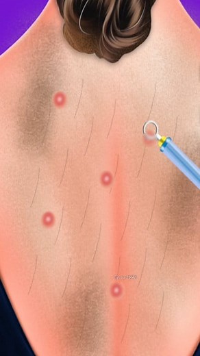 Back Acne Secret Cleaning 😳🔥 | Most Relaxing ASMR Showed This Back pimple remove #asmr #back #cleaning #satisfying #tunnigasmr | Tunnig ASMR