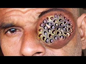 Trypophobia! Blackheads, Cysts, Pimples & Popping Zits!
