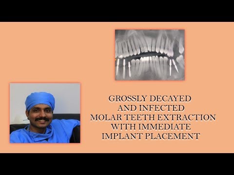 GROSSLY DECAYED AND INFECTED MOLAR TEETH EXTRACTION WITH IMMEDIATE IMPLANT PLACEMENT.