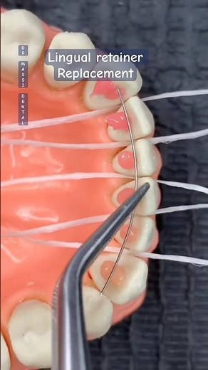 Lingual Retainer replacement easy way