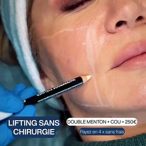 Lifting non chirurgical longue durée Résultats visibles jusqu’à 24 mois ✨ Sans chirurgie • Sans éviction sociale 📍 Disponible dans nos cabinets : Paris • Marseille • Lyon • Lille • Toulouse • Montpellier ⏳ Offre limitée dans le temps 📞 07 56 87 68 84 Appelez ou envoyez un message pour plus d’informations. | Lifting sans chirurgie