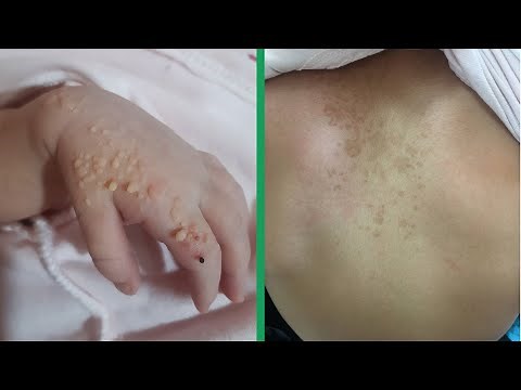 What is Neurofibromatosis? | Atypical and typical cases