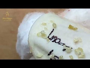 Loan Nguyen Acne Treatment 4013