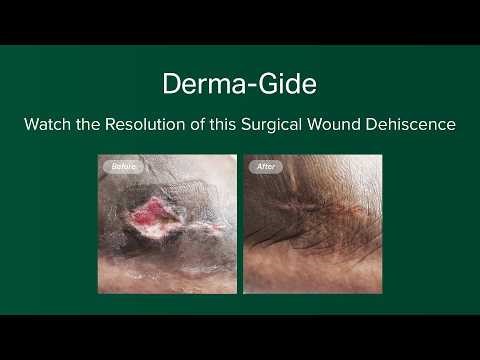 The Treatment of Surgical Wound Dehiscence After Hindfoot Double Arthrodesis Revision with DermaGide