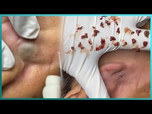 Big Cystic Acne Blackheads Extraction Blackheads & Milia, Whiteheads Removal Pimple Popping