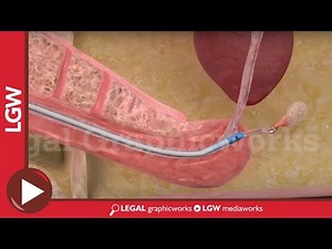 Urethral Catheterization and Rupture 3D animation