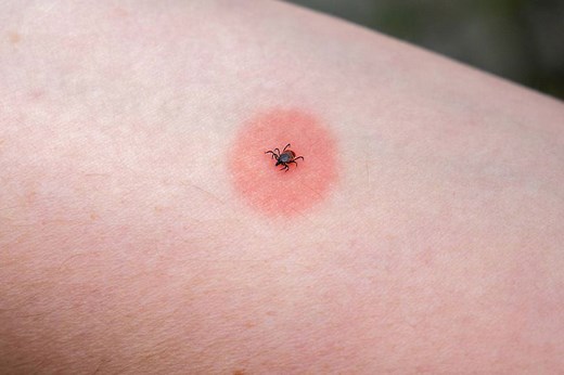 NHS list of 14 different insect bites, their symptoms and how to treat them