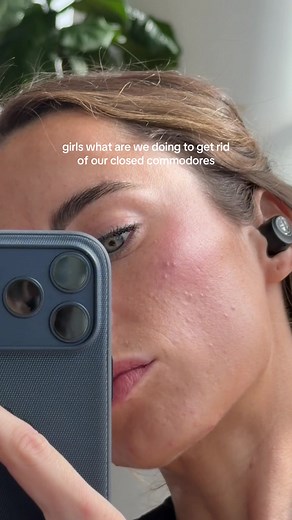 I can’t get rid of mine for the life of me…. I rotate between a retinol and an exfoliate and they won’t budge #closedcomodomes##acneproneskin