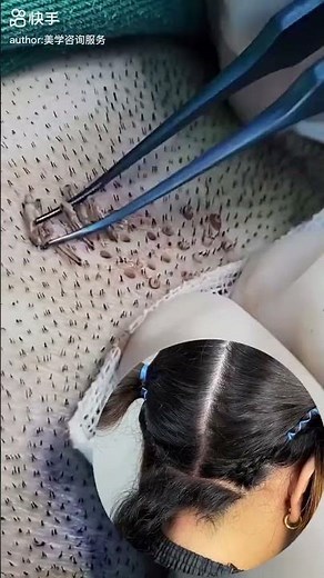 Eyebrow Transplant Explained | Step-by-Step + Healing Process