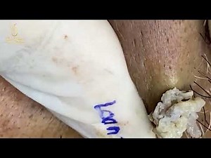Loan Nguyen Acne Treatment 1677mh