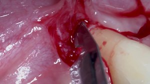 2.5K views · 85 reactions | Coronally Advanced Flap and Connective Tissue Graft  #Dental_Professionals_Summit #The_Genius_Prof Credits: Dr. Fedrico Tirone | The Genius Prof | Facebook
