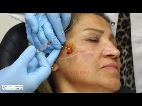 Cheek, preauricular area and tear trough fillers - Dr. Noury Adel
