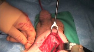 Infrapubic Placement of the AMS 700™ LGX Inflatable Penile Prosthesis with MS Pump™