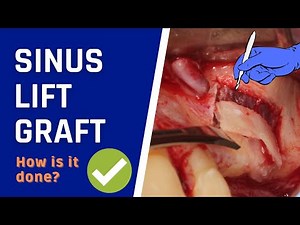 SINUS LIFT surgery with bone graft