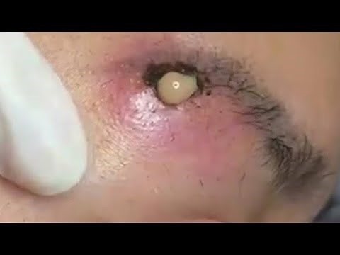 Big Cystic Acne Blackheads Extraction Blackheads & Milia, Whiteheads Removal Pimple Popping #099