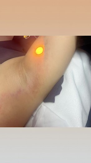 6.6K views · 57 reactions | Improved stretch marks 殺 | Sue-Ing House of Beauty and Wellness | Facebook