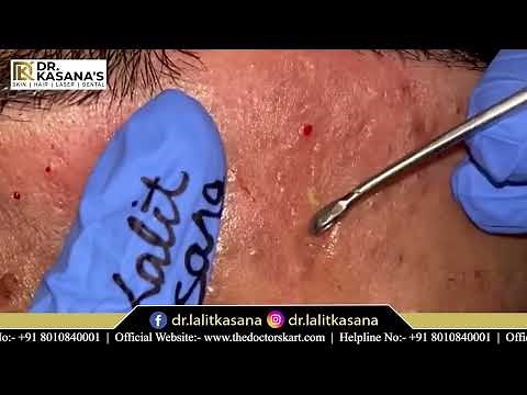 Deep Big Blackheads Removal By Dr Lalit Kasana