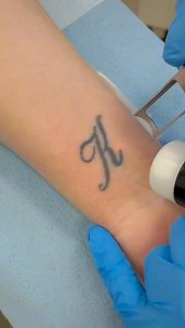 .removed this R #tattoo #tattoos #lasertattooremoval #goviral #laser #viral #viralvideo | Kieran Graham
