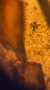 Cercariae at Feces from the human