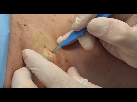 Gambit Part 1, Cyst Treatment, Dr. Gilmore's Birthday!