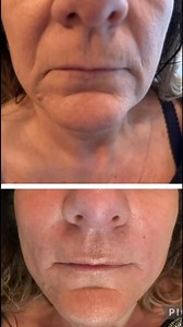 4 ml package £350 client had filler in her 11 lines, Nasal folds, and marionette lines while still keeping it nice and natural looking like my client wanted and as you can see from the before and after 📸😍🧚‍♀️💉✨DM to book or for more information 💜 | Bewitched Beauty