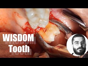 Should you extract the upper wisdom tooth after extracting the lower?