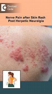 How to Treat Nerve Pain after Skin Rash? | Post Herpetic Neuralgia #doctorscirclespecial #herpesvirus #herpesawareness #nervepain #postherpetic | Doctors' Circle