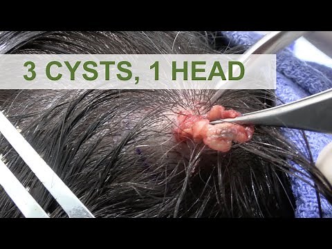 3 Cysts, 1 Head | Dr. Derm