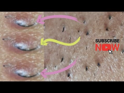 Ingrown hair + thick facial hair extraction