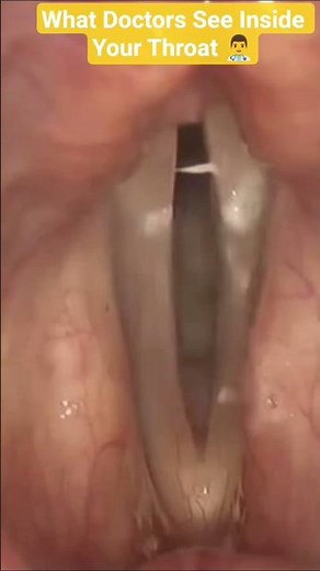 Vocal Cord Health Explained | What Doctors See During a Throat Examination (Educational)