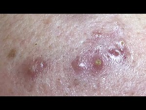 MILIA UNDER EYES and INFLAMED ACNE EXTRACION | Suri Job 120