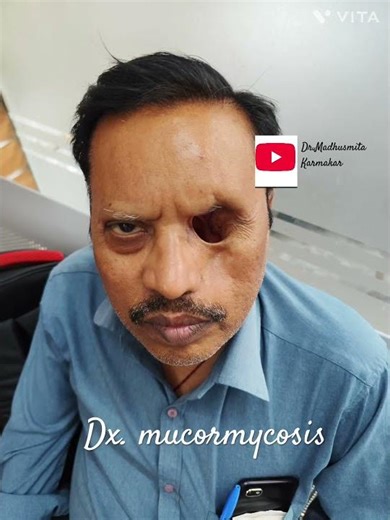 Dx.mucormycosis